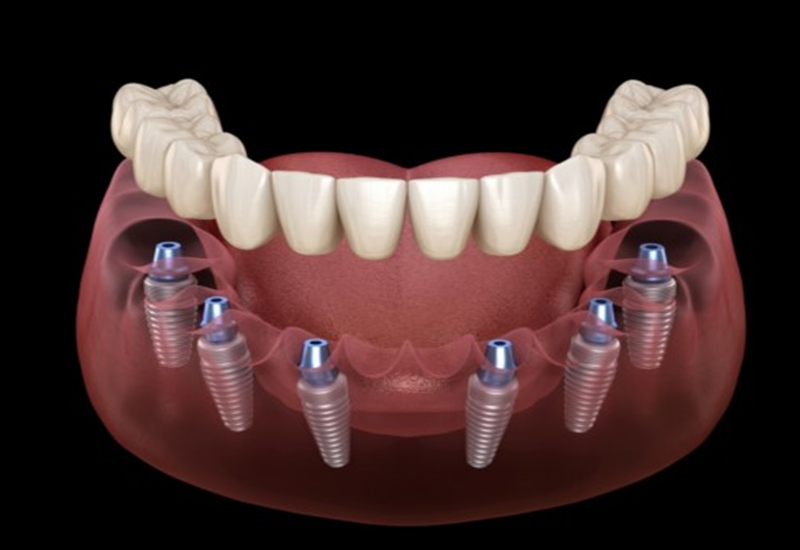 5 lời khuyên trước và sau khi cấy ghép Implant All-on-6