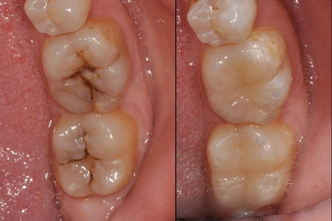 biểu hiện của sâu răng