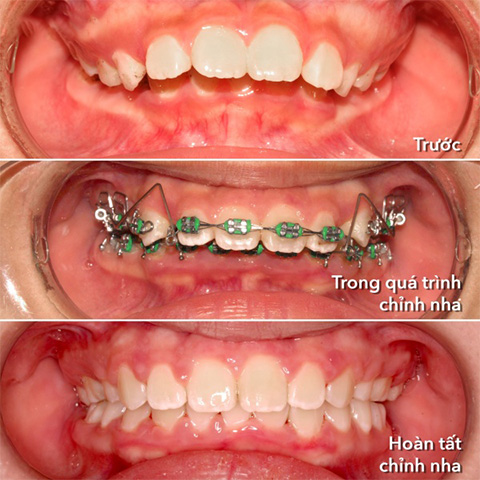 Các giai đoạn niềng răng của trẻ