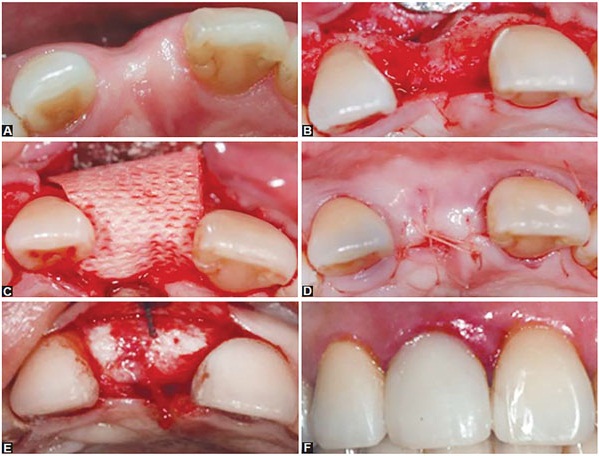 các phương pháp tiểu phẫu