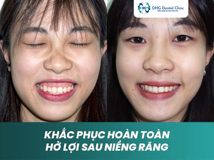 Cách điều trị cười hở lợi