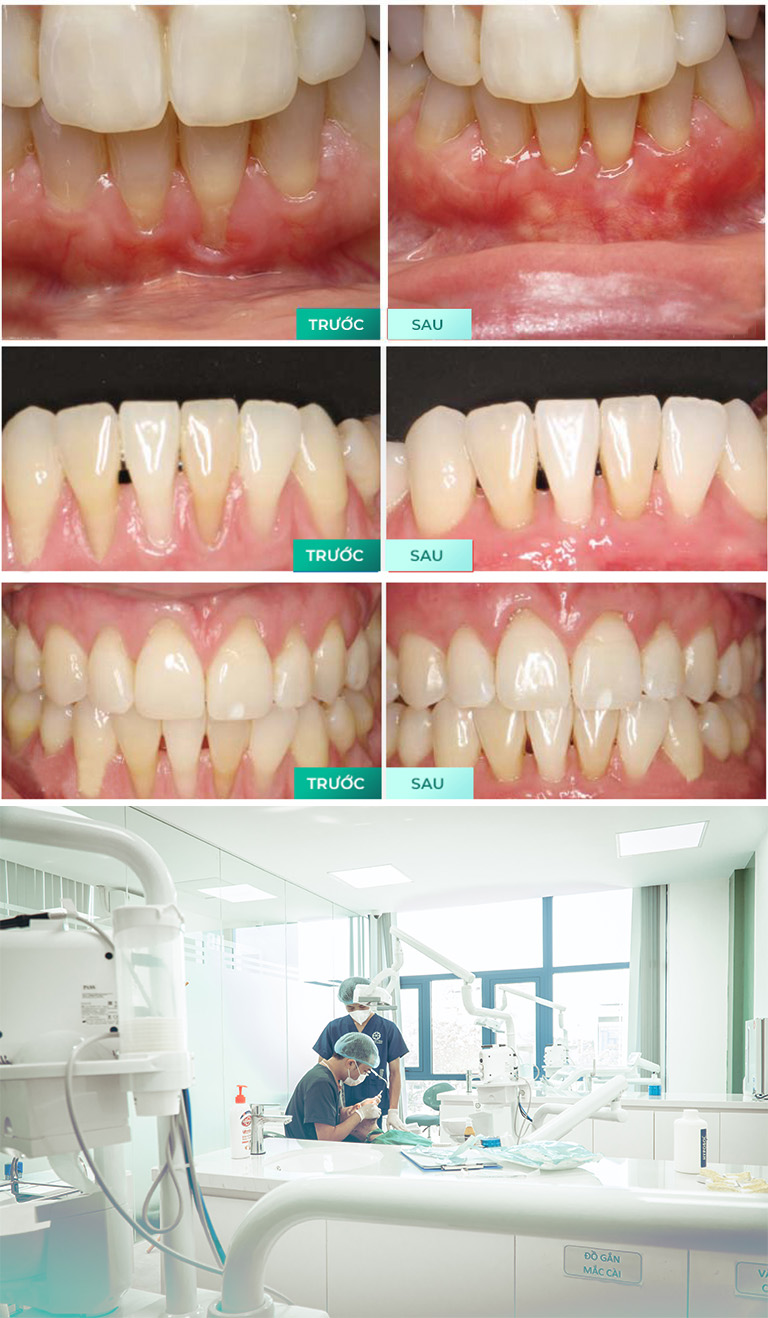 cách điều trị tụt lợi
