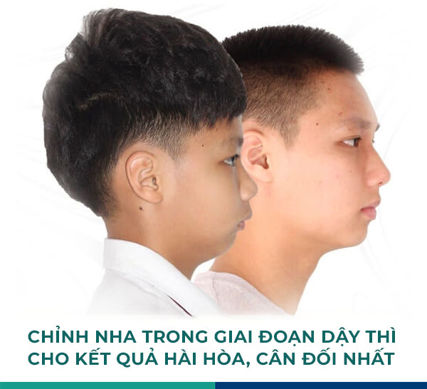 chiỉnh nha tăng trưởng là gì?