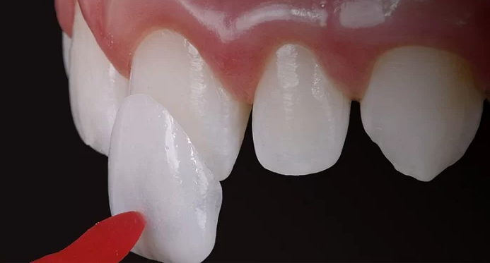 Dán sứ Veneer