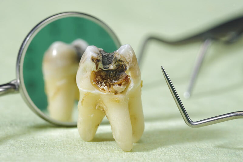 hậu quả của sâu răng