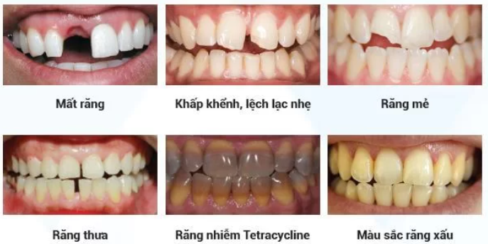 Khi nào nên bọc răng sứ
