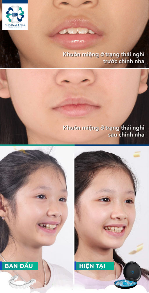 Lợi ích của niềng răng tăng trưởng ở trẻ em giai đoạn thay răng