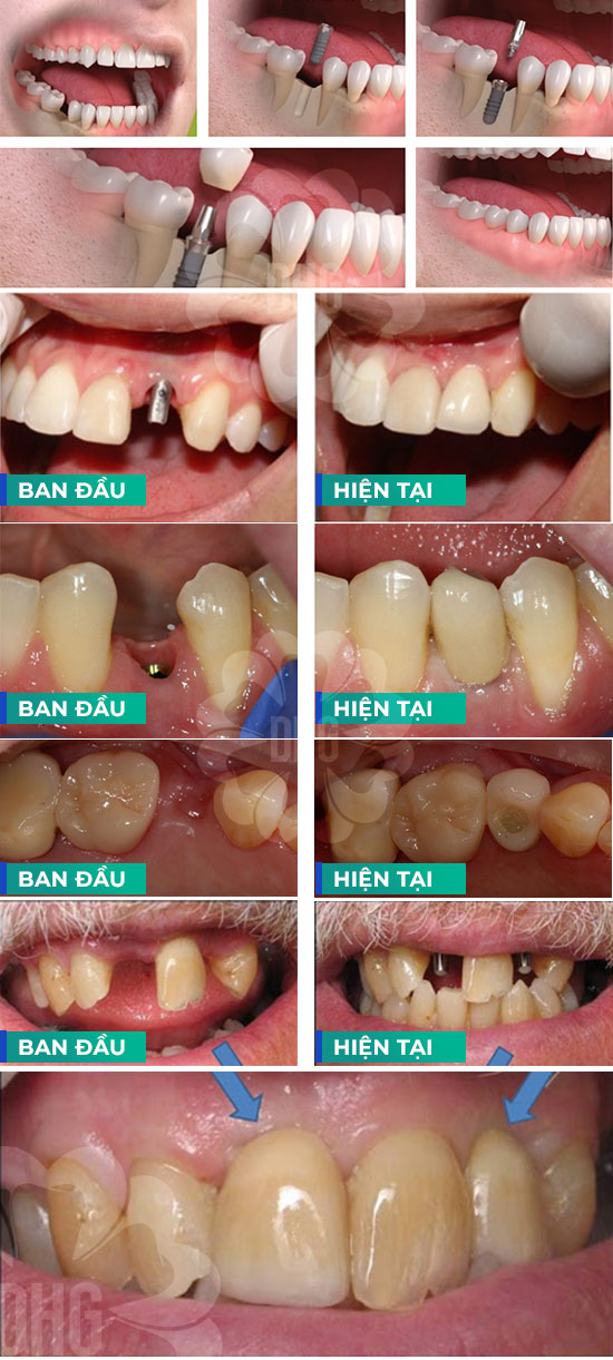 Lưu ý trước và sau khi sử dụng phương pháp trồng răng Implant đơn lẻ