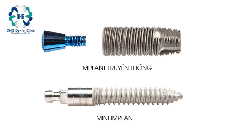 Mini Implant là gì?