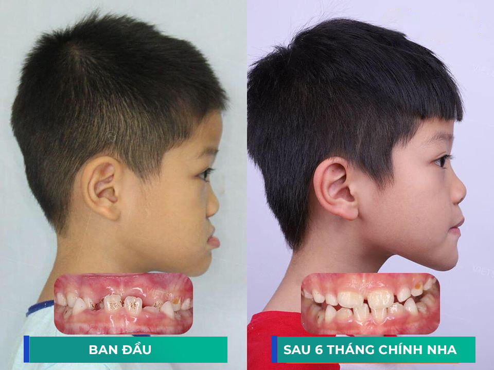 Một số lưu ý chăm sóc răng khi thực hiện niềng răng cho trẻ