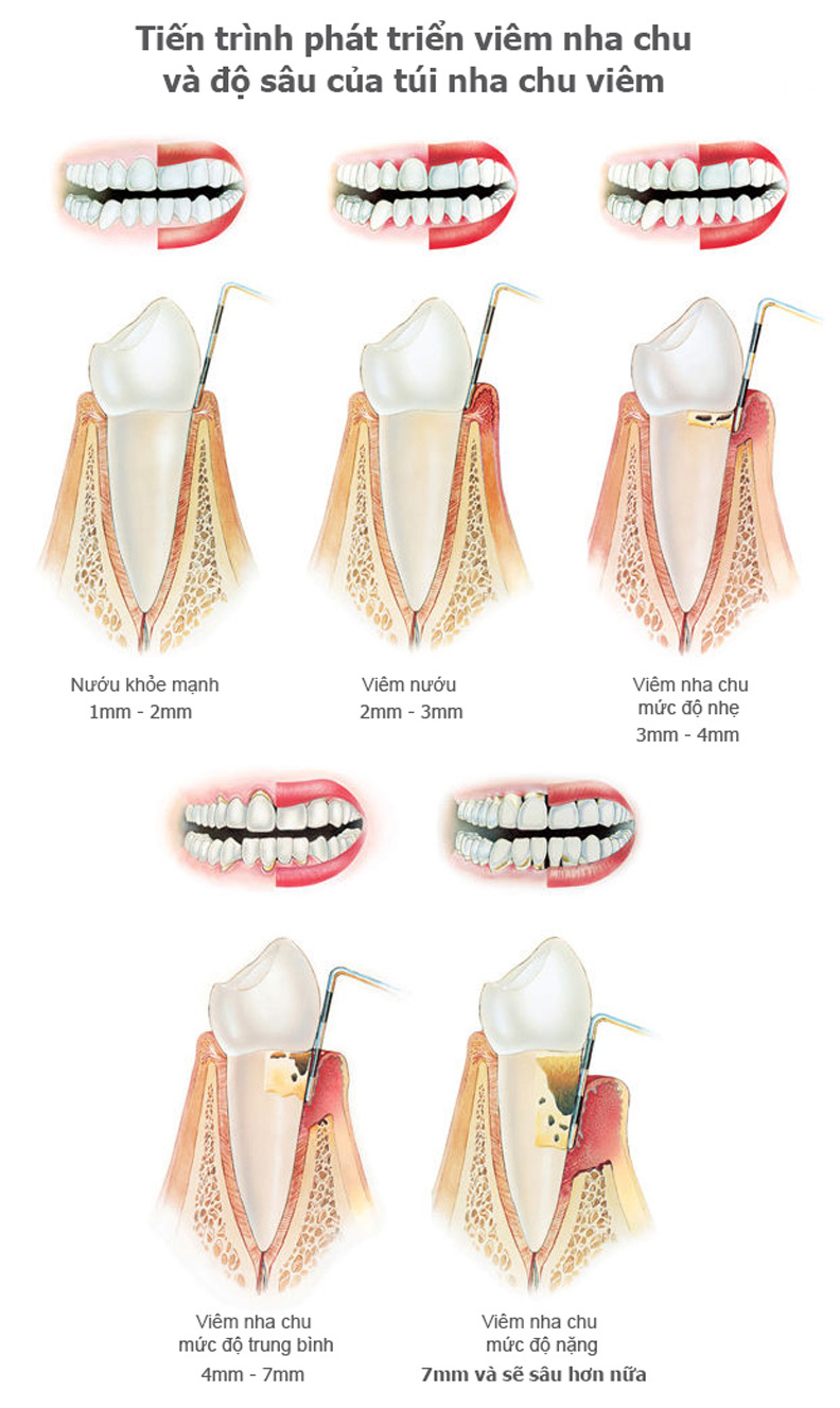 nguyên nhân gây hiện tượng bị tụt lợi chân răng