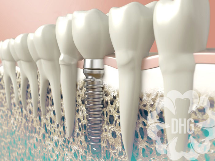 Những trường hợp nên sử dụng mini implant
