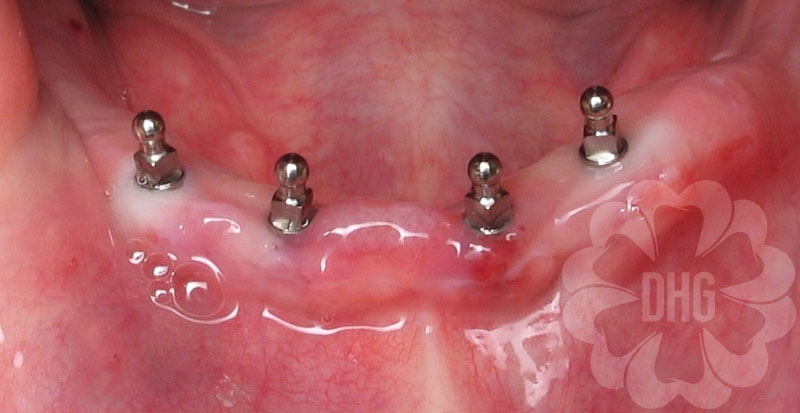 Nhược điểm của cấy ghép implant All On 4