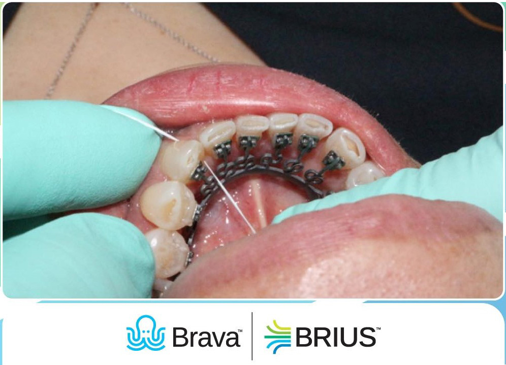 Nhược điểm của phương pháp gắn chỉnh răng Brava là gì?