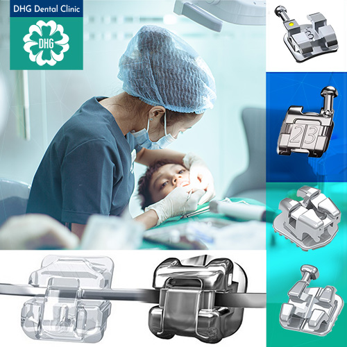Niềng răng mắc cài mặt ngoài