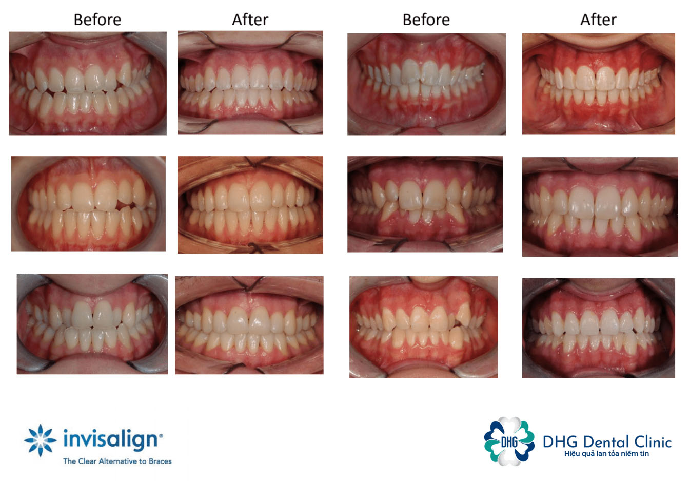 Niềng răng trong suốt invisalign hoạt động như thế nào?