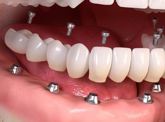 Phương pháp trồng Implant All on 6 (All on Six)