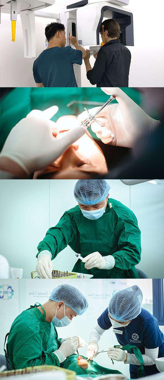 QUY TRÌNH CẤY GHÉP IMPLANT ALL ON 6 TẠI DHG Dental Clinic
