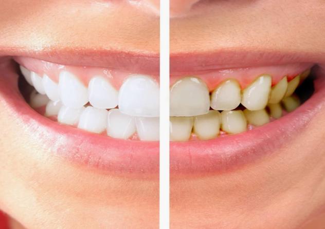 tẩy trắng răng là gì
