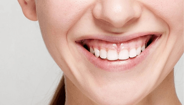 Thế nào là cười hở lợi