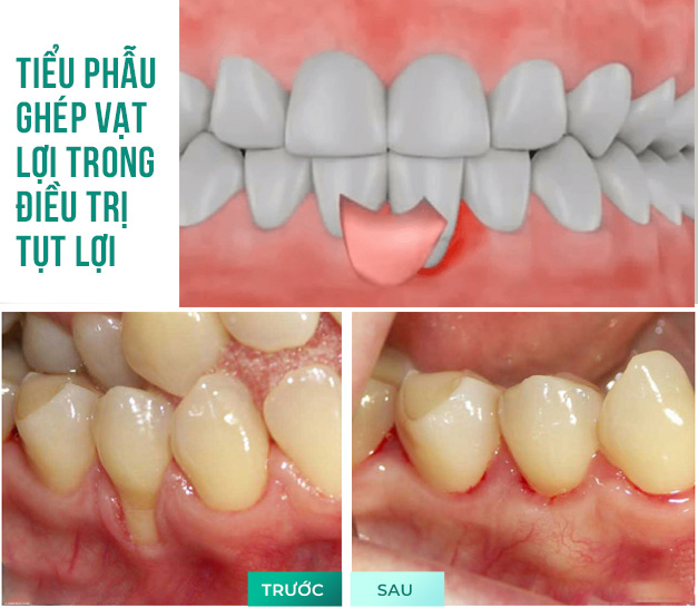 Tiểu phẫu ghép nướu
