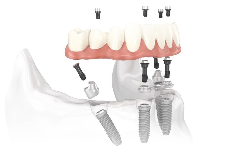 TRỒNG RĂNG IMPLANT ALL ON 4 LÀ GÌ?