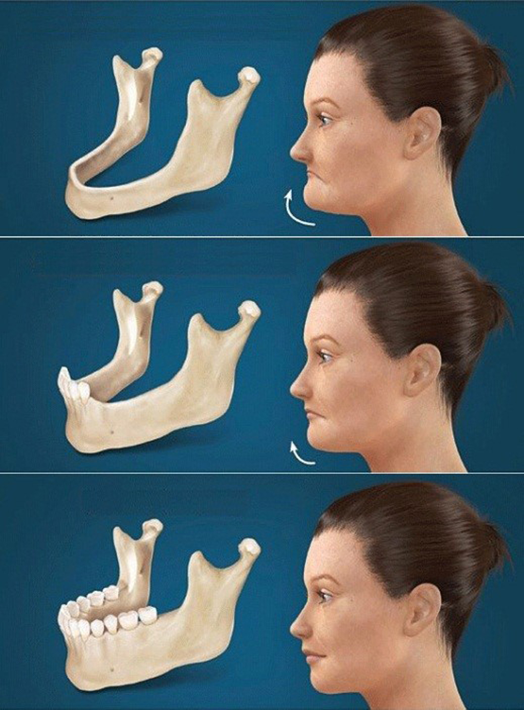 TRỒNG RĂNG IMPLANT ALL ON 4 PHÙ HỢP VỚI ĐỐI TƯỢNG NÀO?
