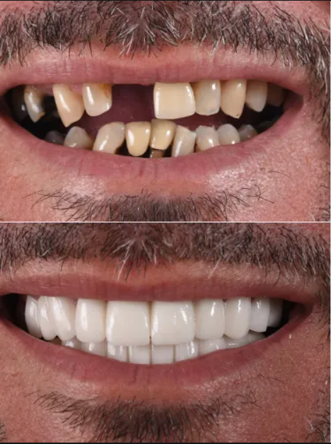 TRỒNG RĂNG IMPLANT ALL-ON-6 PHÙ HỢP VỚI ĐỐI TƯỢNG NÀO?