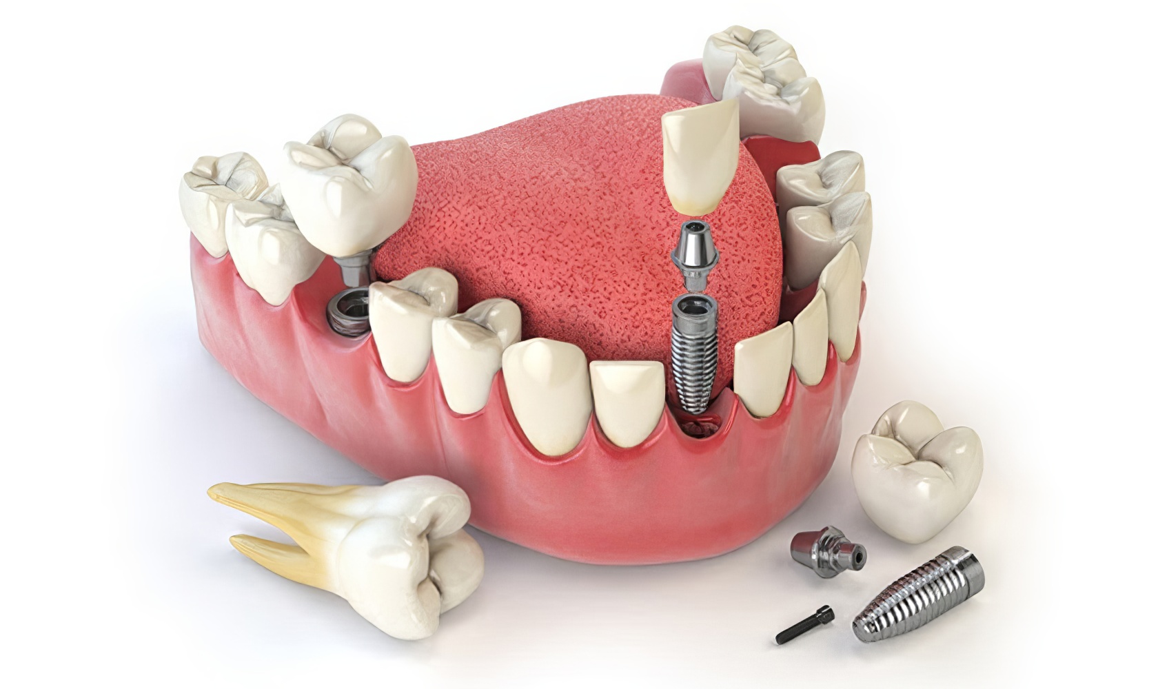 Trồng răng Implant