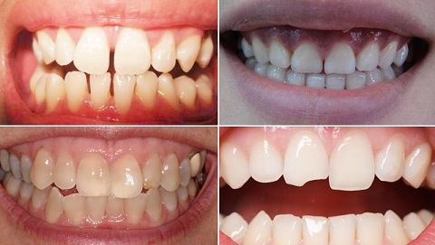 Trường hợp nào nên dán sứ Veneer?