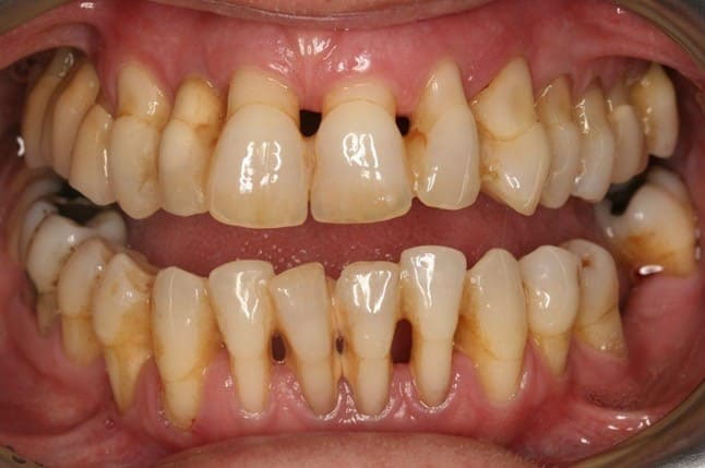 tụt lợi chân răng là gì