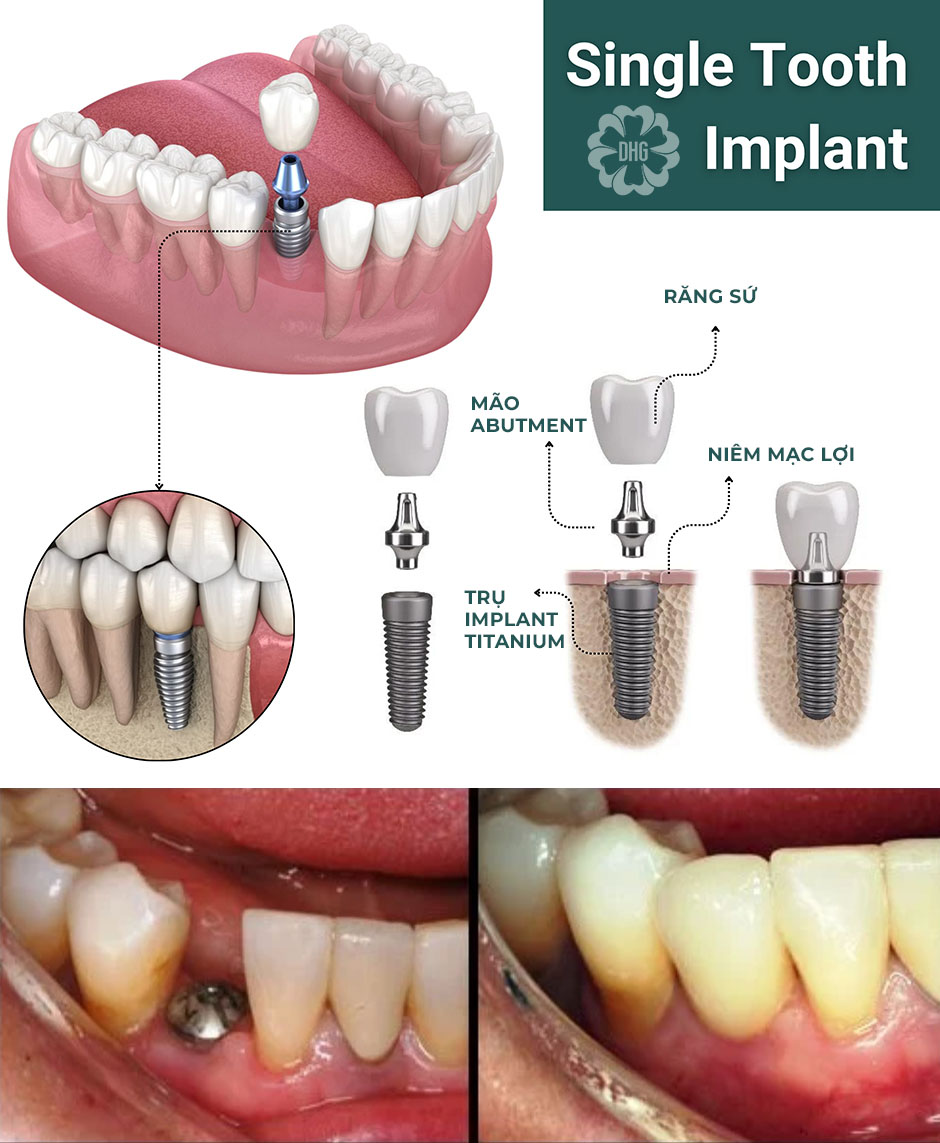 Ưu điểm của kỹ thuật trồng răng Implant đơn lẻ