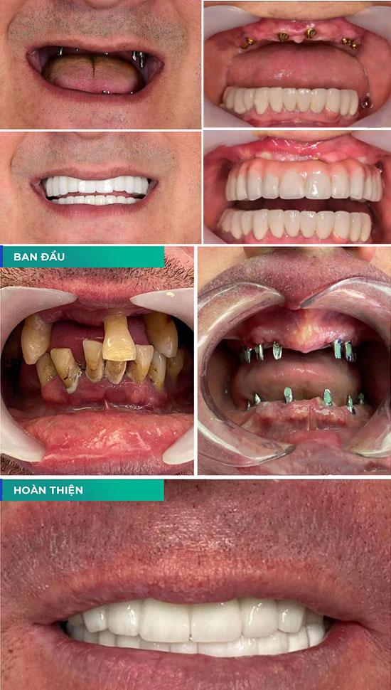 ƯU ĐIỂM CỦA PHƯƠNG PHÁP TRỒNG RĂNG ALL ON 6