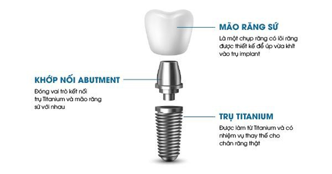 Ưu điểm của trồng răng Implant