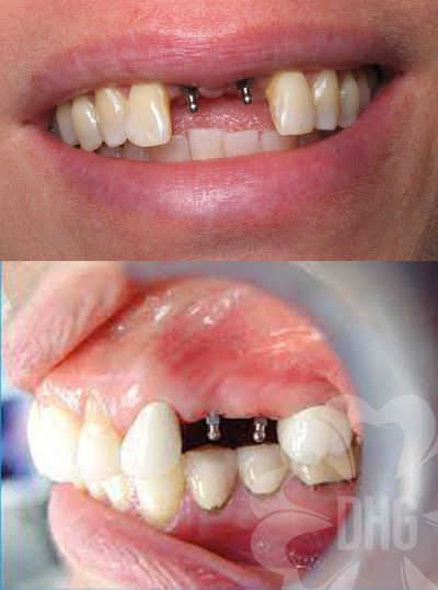 ƯU ĐIỂM, NHƯỢC ĐIỂM CỦA MINI IMPLANT​