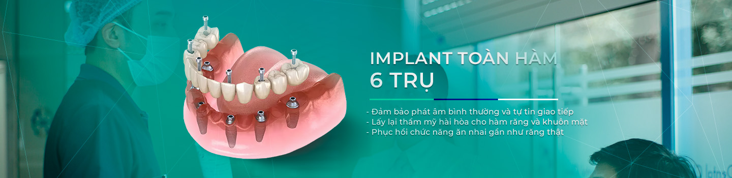 Implant Toàn Hàm 6 trụ