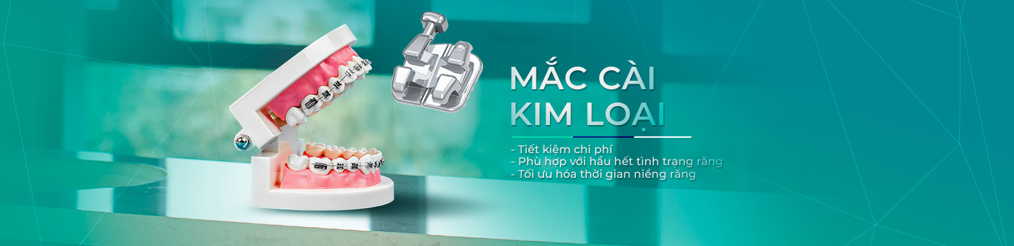 Mắc cài kim loại