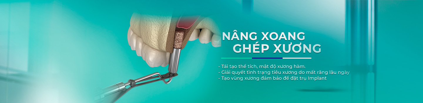 Nâng xoang, Ghép xương