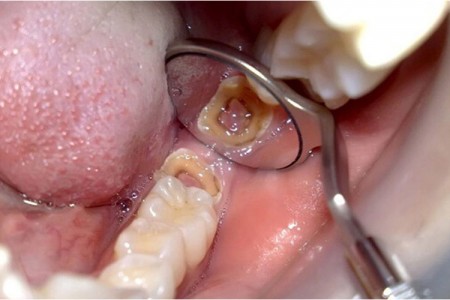Bị sâu răng khôn có nguy hiểm không? Nên nhổ hay trám?