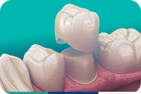 Bọc sứ bảo tồn chức năng