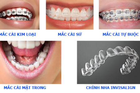 Các phương pháp chỉnh nha hiện đại