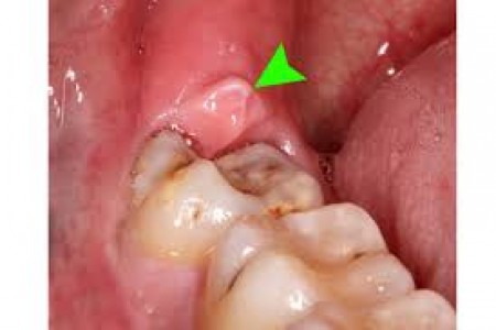 Cách chữa đau răng số 8 (răng khôn)