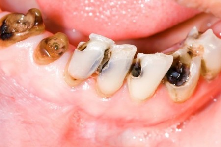 Cách chữa sâu răng cho người lớn