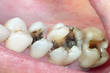 Cách chữa sâu răng hiệu quả