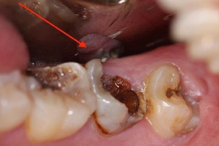 CẦN LÀM GÌ KHI TỦY RĂNG BỊ THỐI? NGUYÊN NHÂN, TRIỆU CHỨNG VÀ CÁCH ĐIỀU TRỊ TÙY TỪNG TÌNH TRẠNG