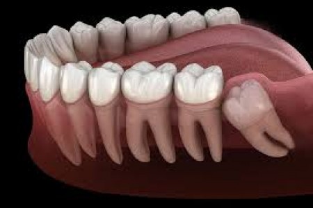 Có nhất thiết phải nhổ răng khôn không?