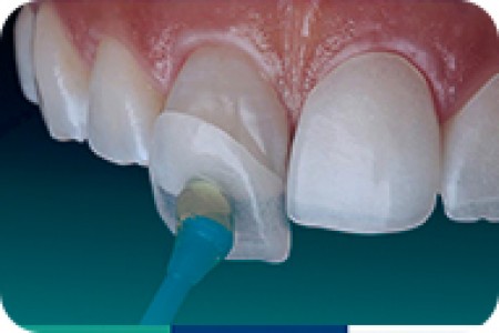 Dán sứ thẩm mỹ Veneer