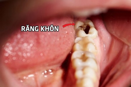 Dấu hiệu nhận biết răng khôn bị sâu và cách xử lý