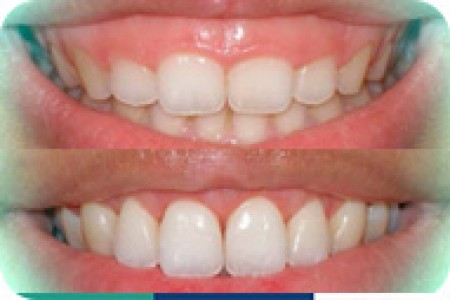 Điều trị cười hở lợi