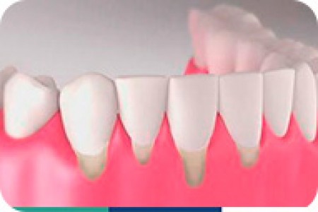 Điều trị tụt lợi